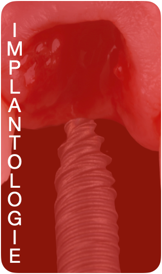 Implantologie